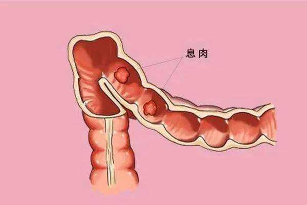 生姜加什么能消腸息肉的（生姜加什么能消腸息肉的息肉呢）-圖3