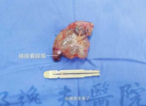 囊腺瘤手術(shù)后能吃生姜嗎（囊腺瘤手術(shù)后能吃生姜嗎有影響嗎）-圖3