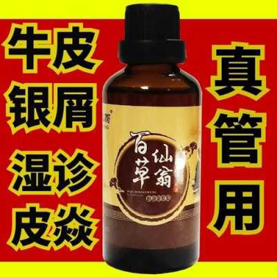 牛皮癬能用生姜泡酒擦癬嗎（牛皮廨可以用生姜片擦嗎）-圖2