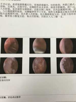 宮腔鏡疤痕可以用生姜擦嗎（宮腔鏡手術(shù)后可以貼膏藥嗎）