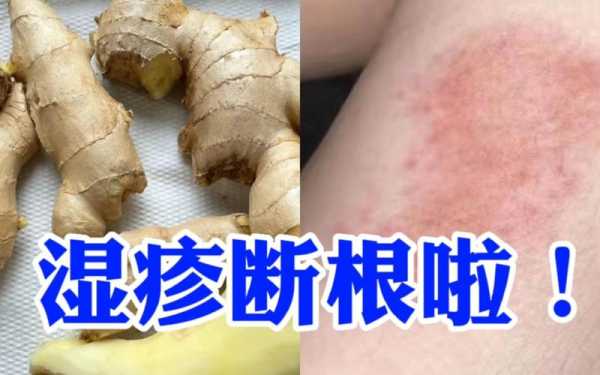 濕疹可以用生姜包腳嗎（濕疹用生姜來涂會(huì)好嗎）