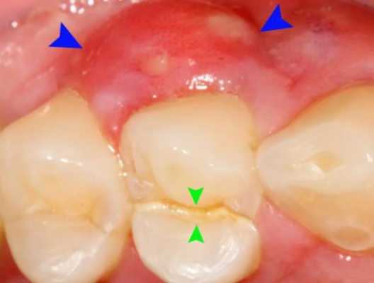牙齦化膿生姜（牙齦發(fā)炎用姜敷有用嗎）-圖2