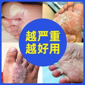 腳趾頭癢用生姜可以嗎（腳趾癢可以直接用鹽擦嗎）-圖3