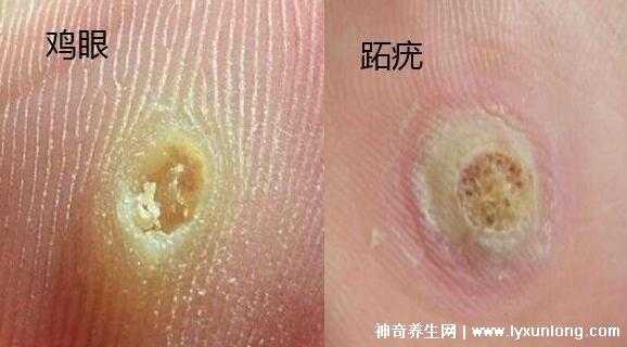 生姜可治雞眼（雞眼用生姜擦有用嗎）