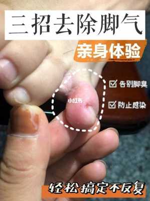 吃生姜腳跟外側(cè)刺癢